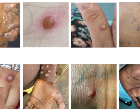 photo of Examples of monkeypox rashes